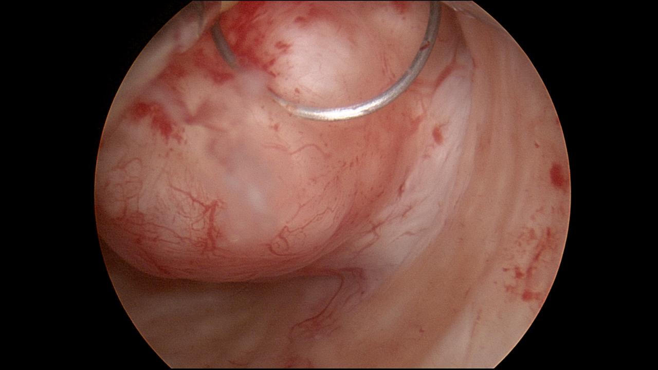 Submucus Fibroid Hysteroscopic Resection 3